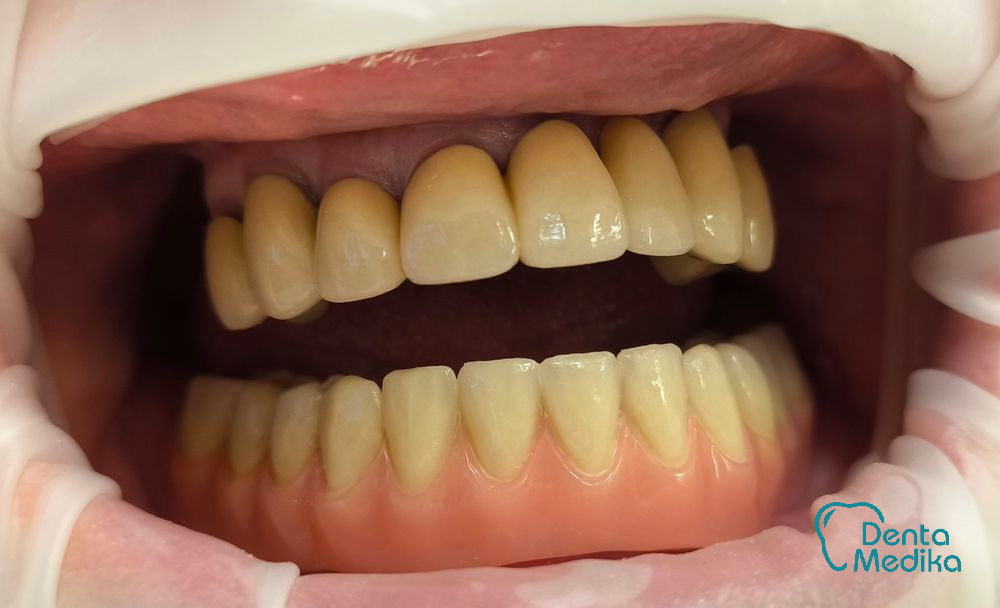 Třmenová hybridní náhrada na implantátech pro bezzubou čelist 7